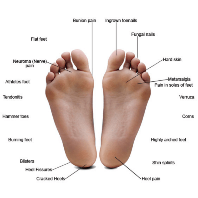 Treating painful foot conditions