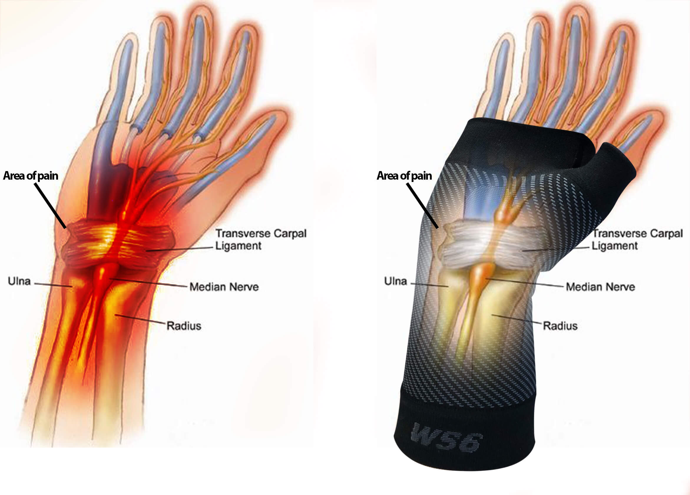 WS6 Performance Wrist Sleeve For Pain Relief